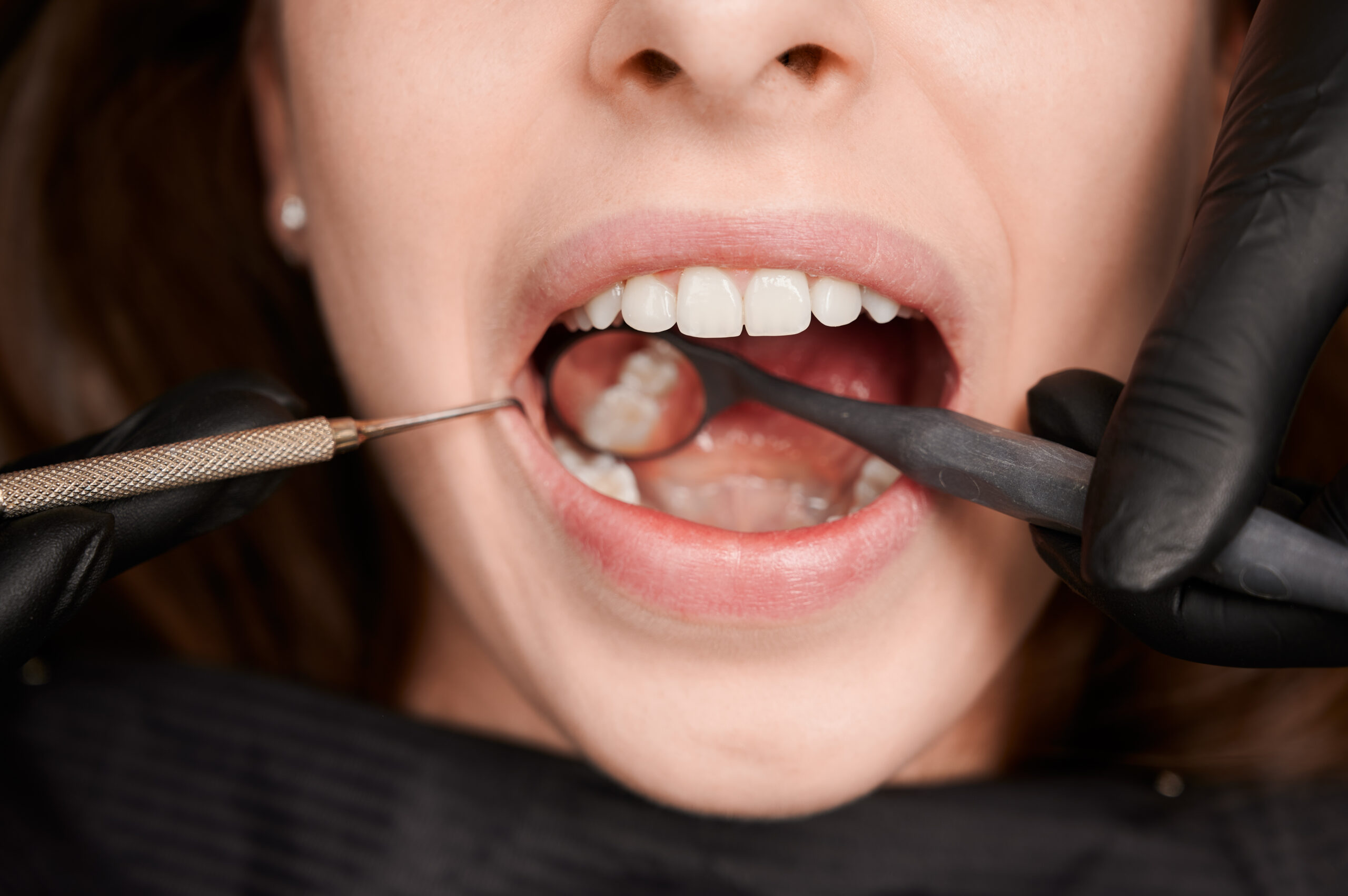 Stop Cavities Early and Protect Your Smile